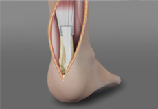 Achilles Tendon Repair