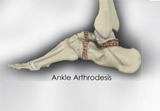 Ankle Arthrodesis