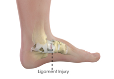 Ankle Ligament Injury