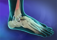 Ankle Ligament Reconstruction