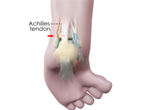 Ankle Tenotomy