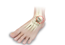 Foot and Ankle Arthritis