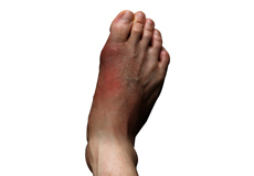 Foot Infections